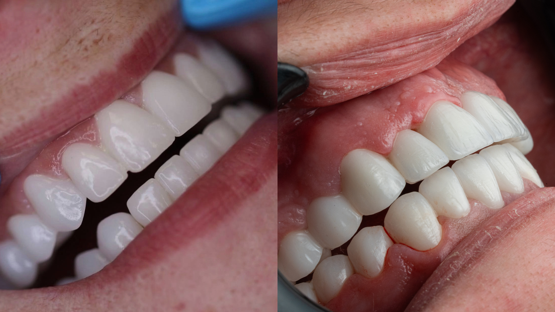 Before and after clinical case comparison, case 3