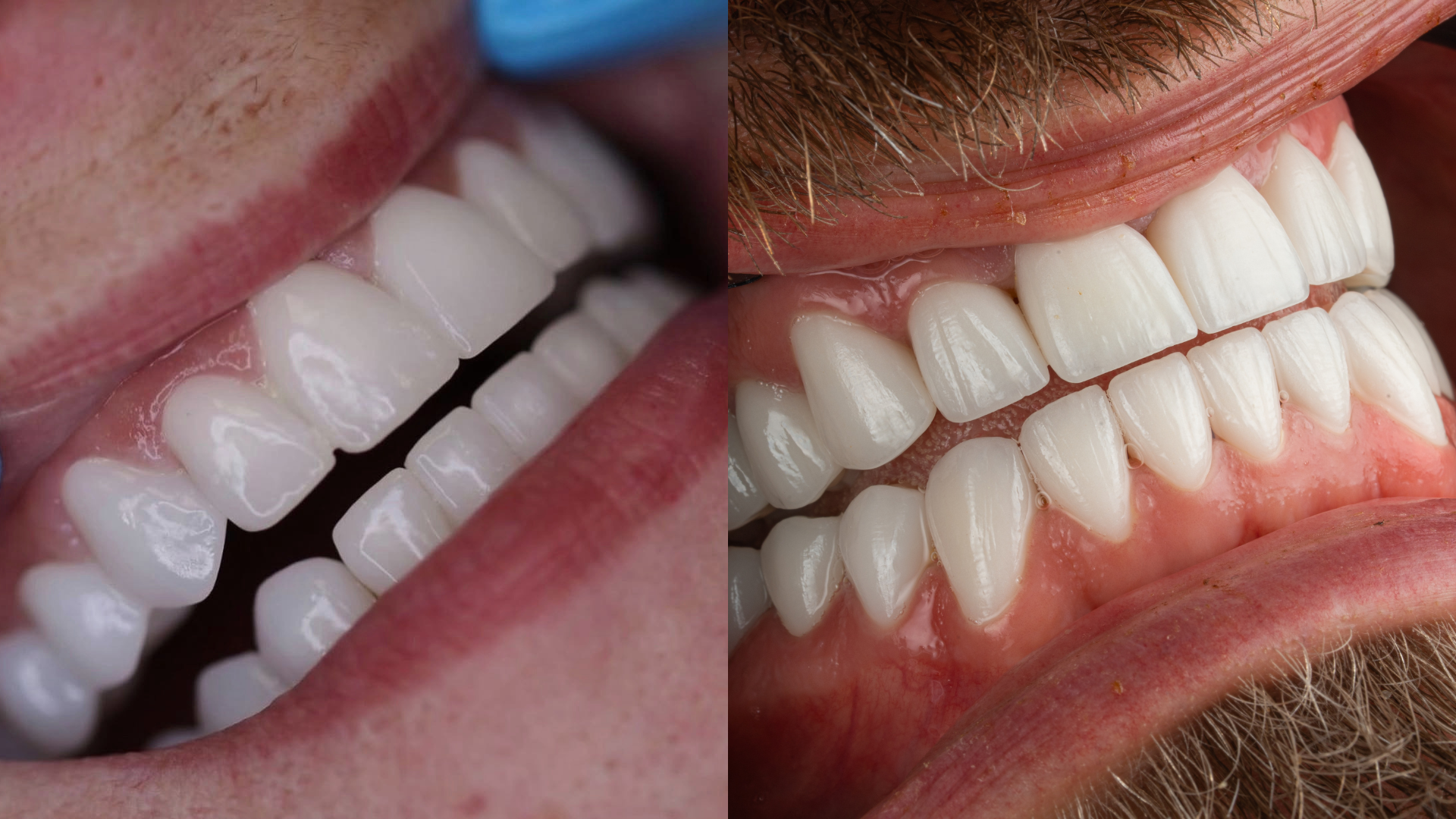 Before and after clinical case comparison, case 1