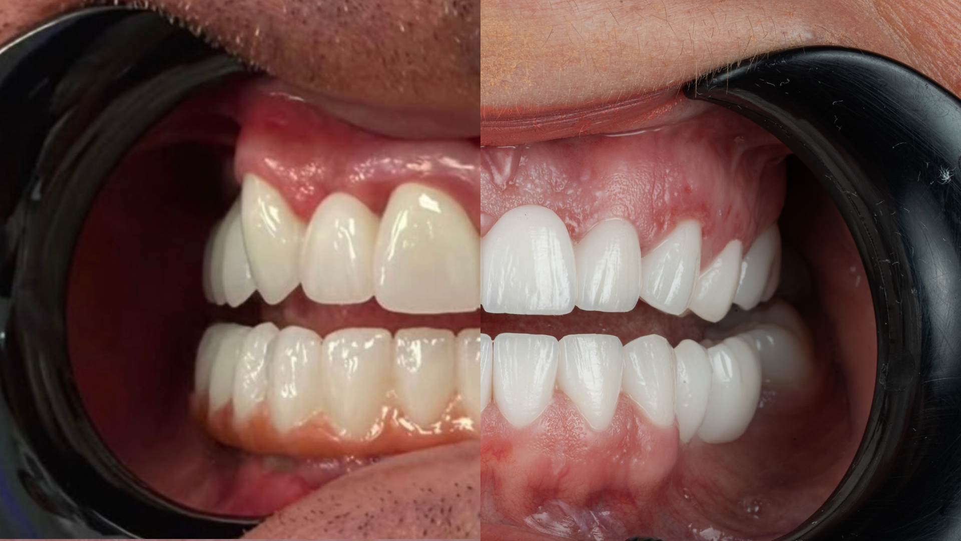 Before and after clinical case comparison, case 4